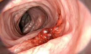 پیشگیری از سرطان روده بزرگ با یک کار ساده