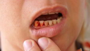 یکی از علائم بیماری اسکوروی خونریزی از لثه ها است