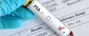 تست PSA روشی برای تشخیص زودهنگام سرطان پروستات می باشد
