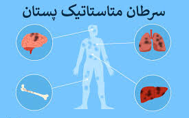 سرطان متاستاتیک پستان