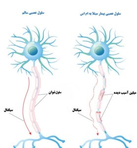 ویتامین د3 در پیشگیری و درمان بیماری ام اس،موثر است