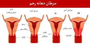 پیشگیری از سرطان دهانه رحم