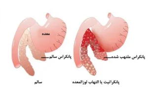 از عوارض مصرف الکل،ایجاد التهاب در پانکراس است